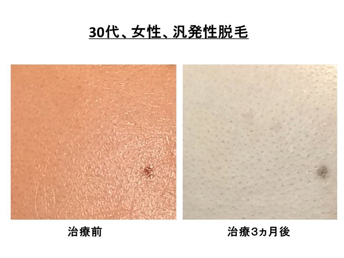 ”円形脱毛症　病院"